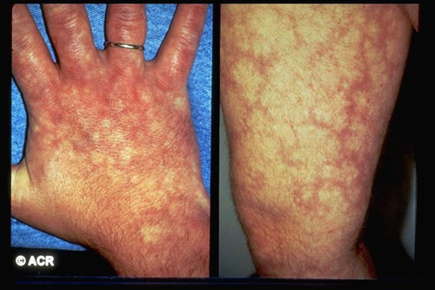 <p>what are the sxs/s of polyarteritis nodosa (PAN)?</p>