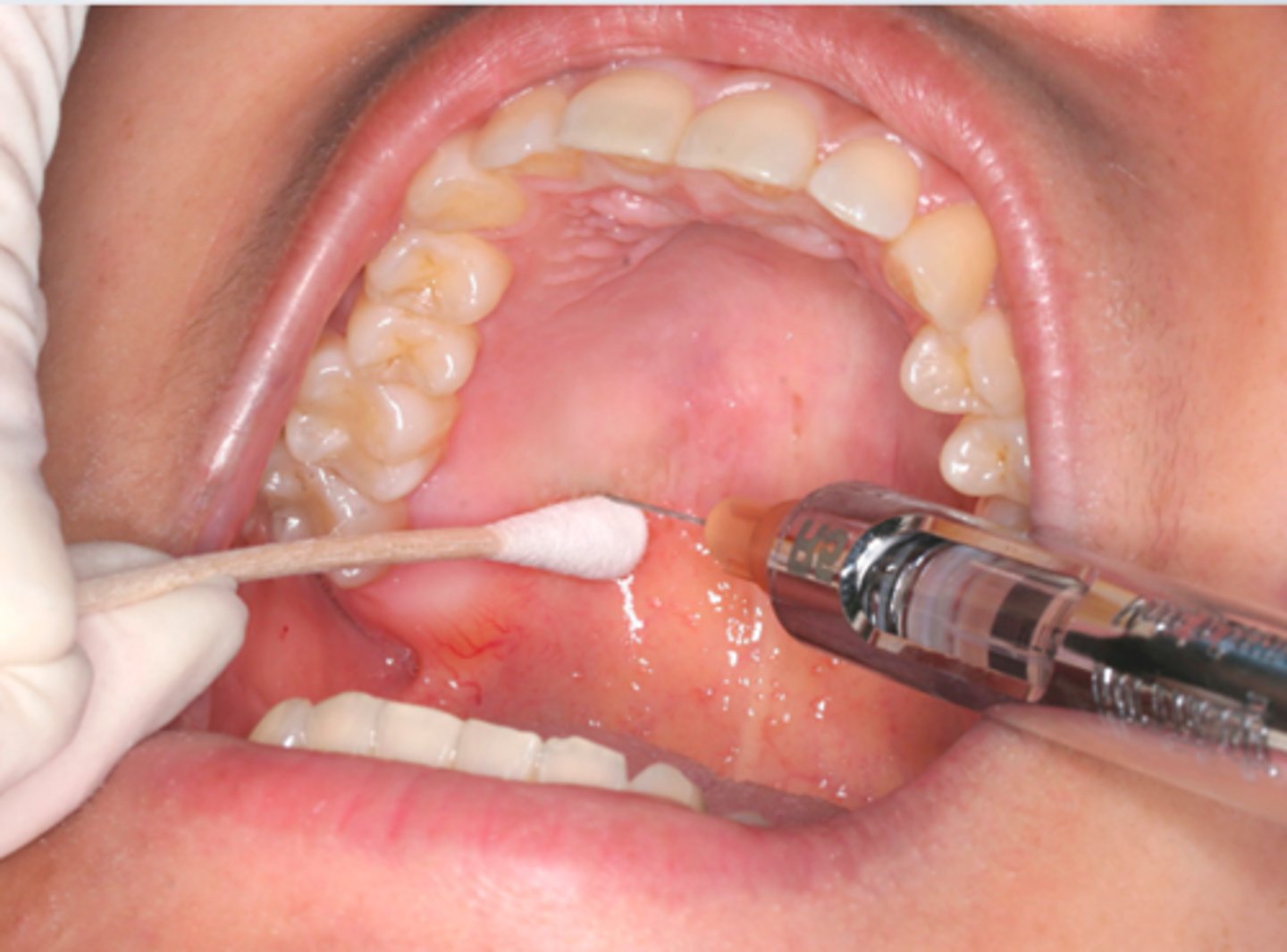 <p>ID the anesthesia technique:</p>