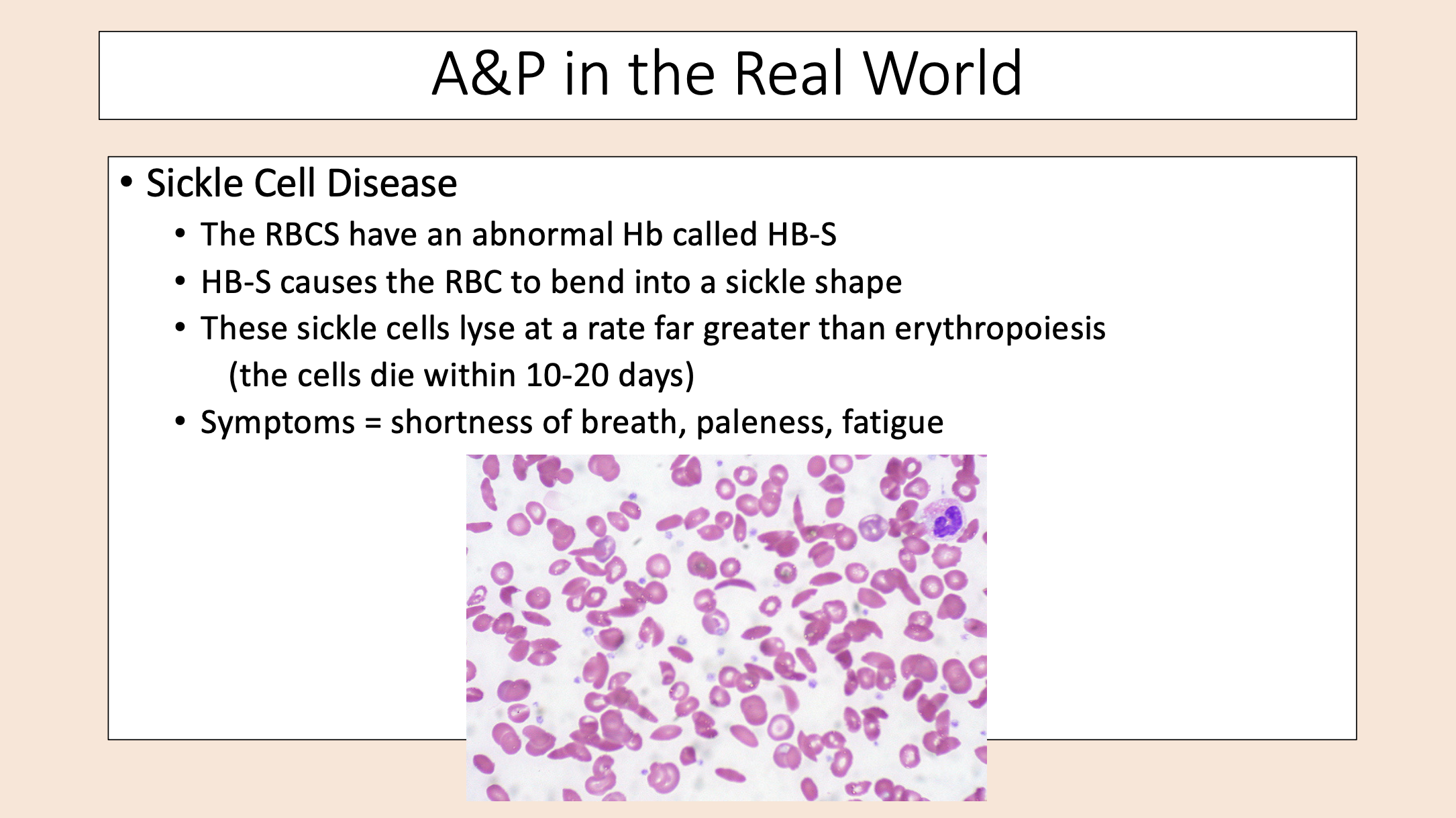 <p><span>• The RBCS have an abnormal Hb called HB-S.</span></p><p><span>• HB-S causes the RBC to bend into a sickle shape.</span></p><p><span>• These sickle cells lyse at a rate far greater than erythropoiesis (the cells die within 10-20 days).</span></p><p><span>• </span><span><span>Symptoms = shortness of breath, paleness, fatigue</span></span></p>