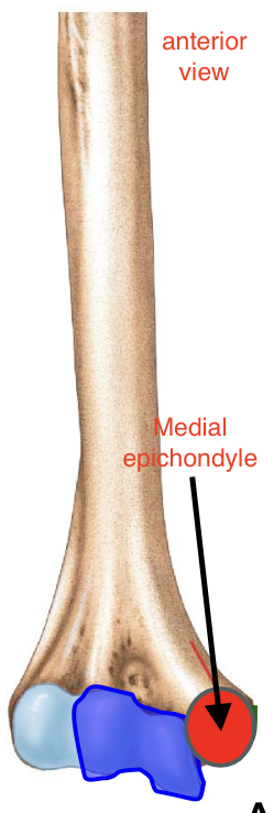 <p>Medial Epicondyle of the Humerus </p>