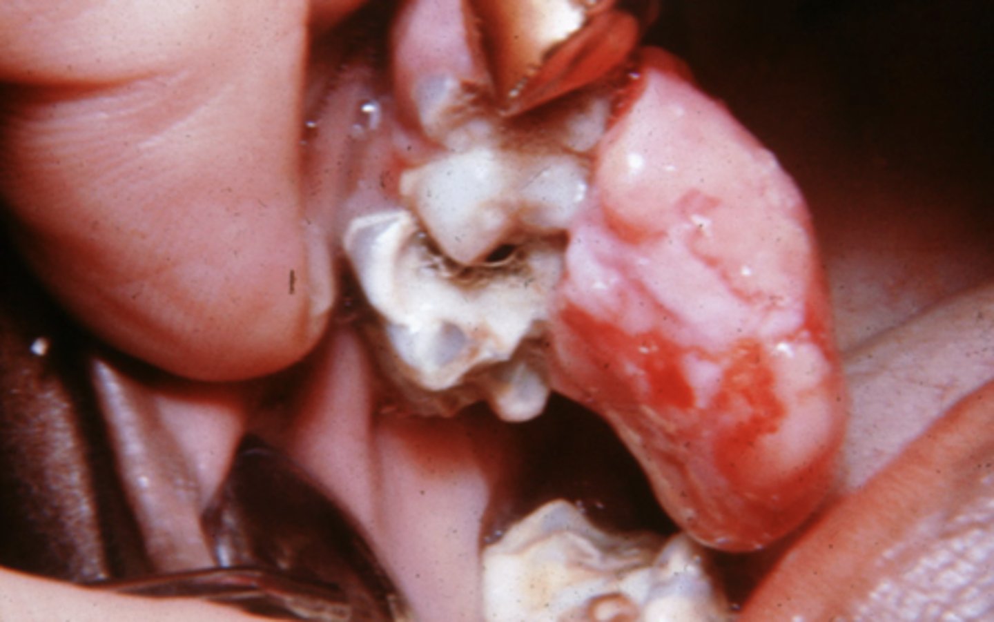 <p>benign lesion where bone proliferates from a reaction to plaque and calculus</p><p>extraction of surrounding teeth may be necessary when these are present</p>