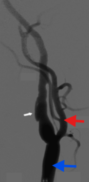 <ol><li><p>What exam is seen here?</p></li><li><p>If this was imaged at the neck, what vessel is the white arrow?</p></li><li><p>Red arrow?</p></li><li><p>Blue arrow?</p></li></ol><p></p>