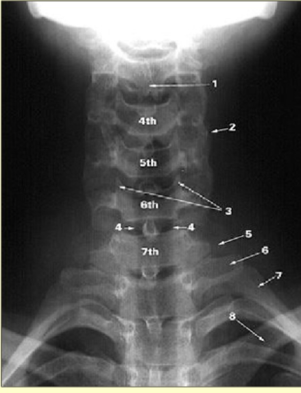 <ol><li><p>bifid spinous process of C3</p></li><li><p>superimposed articular processes</p></li><li><p>uncinate process</p></li><li><p>trachea</p></li><li><p>transverse process of C7</p></li><li><p>transverse process of T1</p></li><li><p>1st rib</p></li><li><p>clavicle</p></li></ol><p></p>