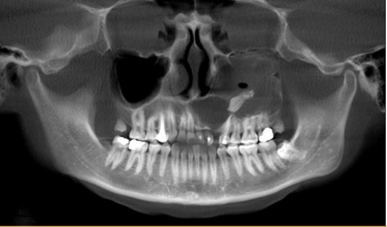 <p>A 25 year old patient present with mild swelling of front jaw. Intra orally a small swelling was visible left vestibular region molar region and 23 was missing. A radiograph taken. Provide Differential diagnosis</p>