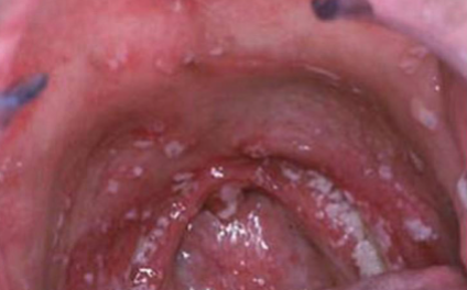<p>occurs after radiation </p>