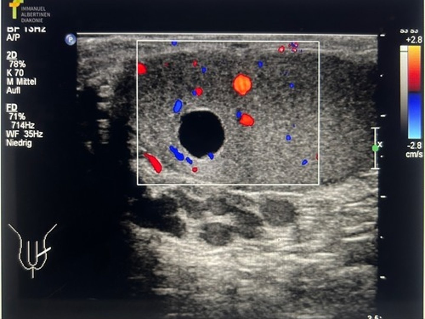 <p>intratesticular cyst and extratesticular varicocele</p>