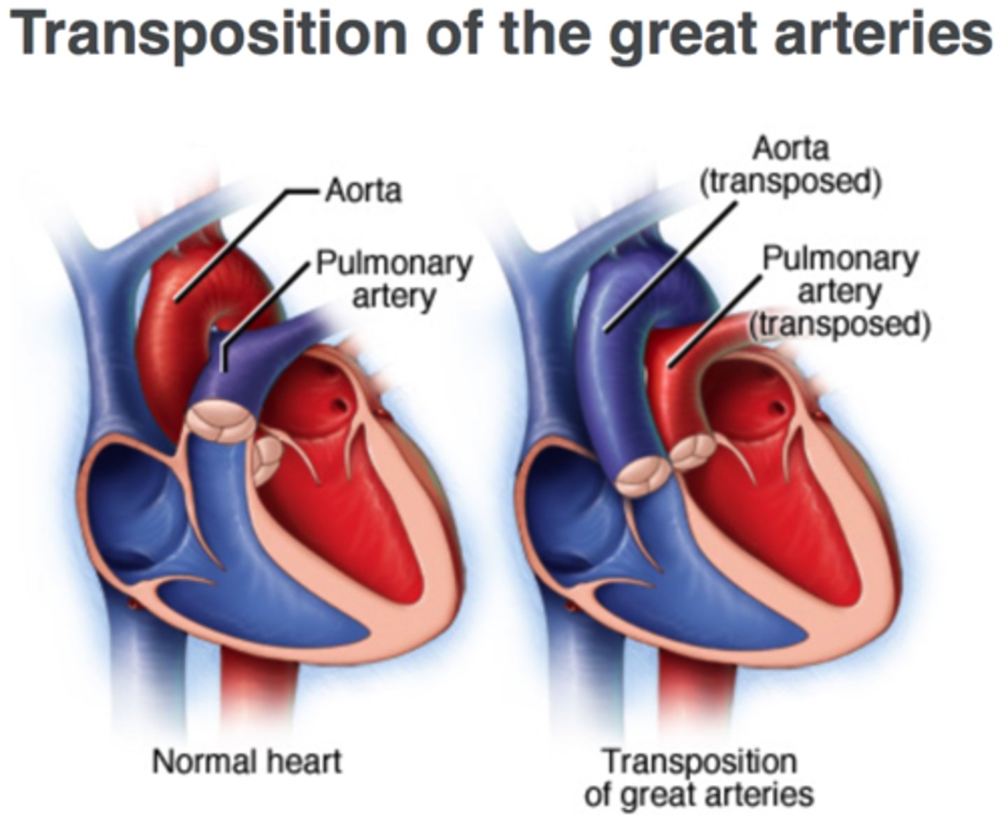 <p>Aorta and pulmonary artery are switched</p><p>- 2 separate pathways instead of 1</p><p>- parellel circulation</p><p>- FATAL if untreated</p><p>- deoxygenated blood circulates the body</p><p>- oxygenated blood keeps recirculating to lungs</p><p>- severe cyanosis and death</p>