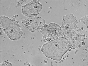 Squamous epithelial cell with G. vaginalis