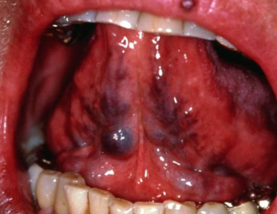 <p>dilated veins located on the ventral/lateral surface of the tongue, most common <strong>over age 60</strong></p>