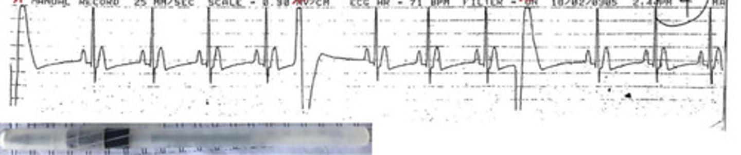 <p>Why is this arrhythmia scary?</p>