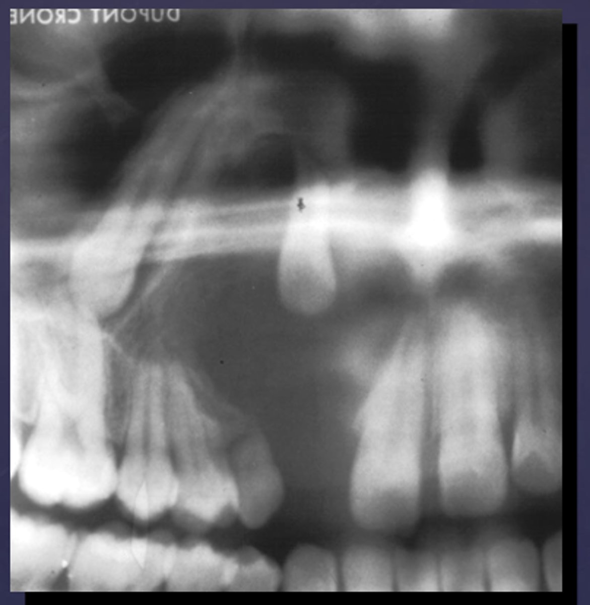 <p>What would be a differential diagnosis for this lesion?</p>