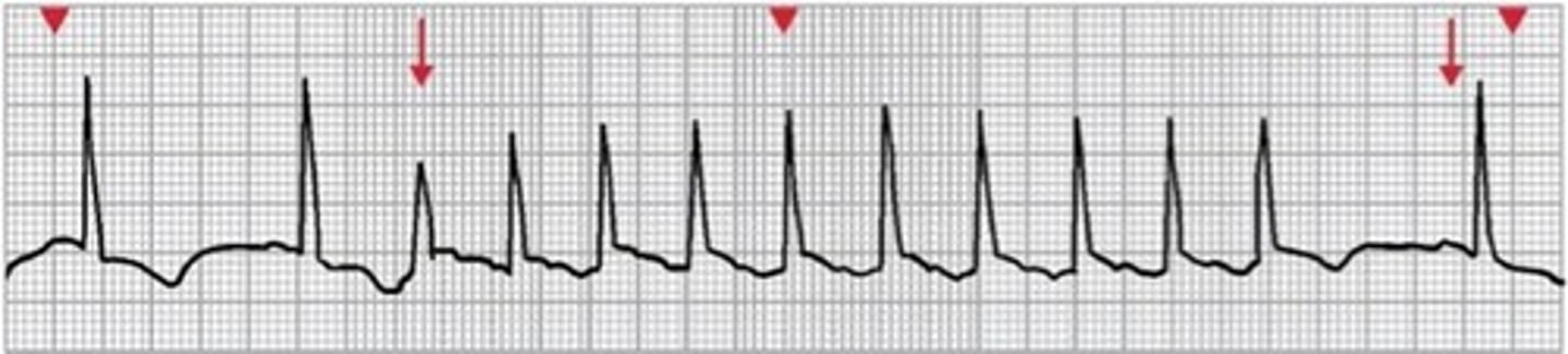 <p>- ectopic focus above the bundle of his causes the ventricles to go too fast (rate of 120-220 BPM)</p><p>- Abrupt onset and termination of symptoms</p><p>- Associated with overexertion, stress, stimulants, and dig toxicity</p><p>- S/S: hypotension, dyspnea, angina</p><p>- Treatment: vagal nerve stimulation, adenosine, beta blockers, CCBs, amiodarone, cardioversion</p>