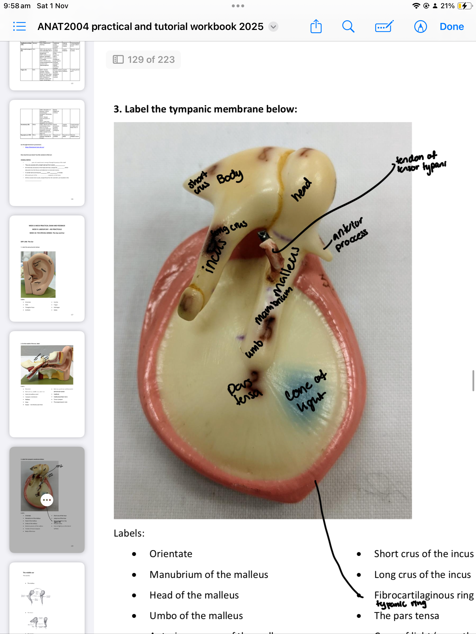 <ul><li><p>Cone of light&nbsp;</p></li><li><p>Manubrium of the malleus</p></li><li><p>Head of the malleus </p></li><li><p>Umbo of the malleus </p></li><li><p>Anterior process of the malleus </p></li><li><p>Tendon of tensor tympani </p></li><li><p>Body of the incus </p></li><li><p>Short crus of the incus </p></li><li><p>Long crus of the incus </p></li><li><p>Fibrocartilaginous ring </p></li><li><p>The pars tensa</p></li></ul><p></p>