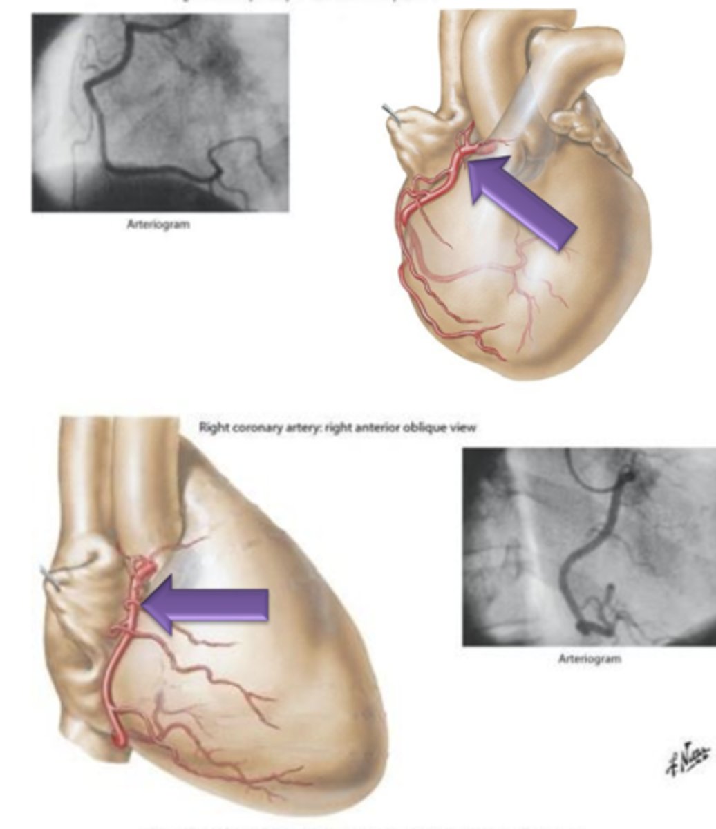 <p>Artery that originates from the right side of the aorta, courses underneath the right auricle and continues to the posterior surface of the heart.</p>