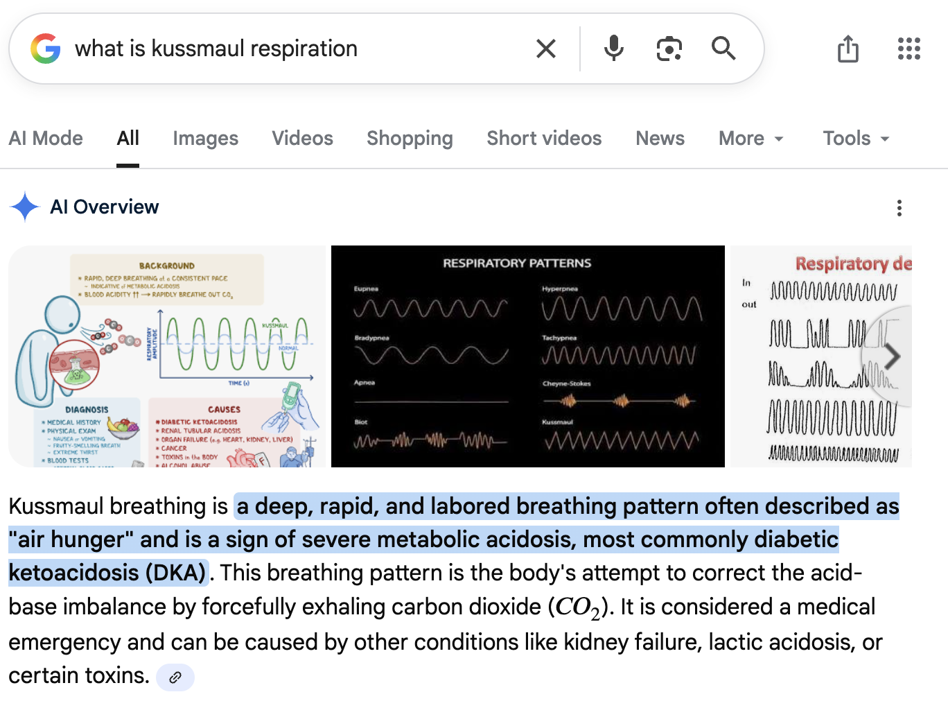 <p>Seen in hyperglycemia, it’s <span style="color: blue;"><strong><span>deep, rapid, and labored breathing pattern often described as "air hunger"</span></strong></span></p>