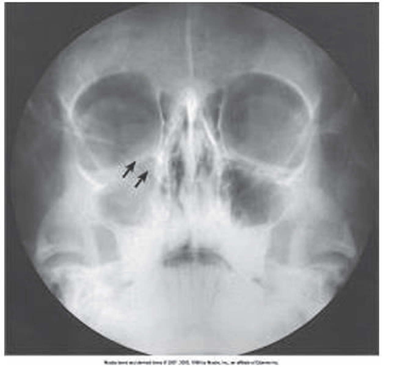 <p>a. Parietoacanthial (Waters)</p>