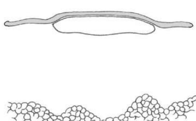 <p>Elevación sólida de la piel, de superficie plana, más área que altura</p><p>Placas eosinofílicas, neoplasias y calcinosis cutis</p>