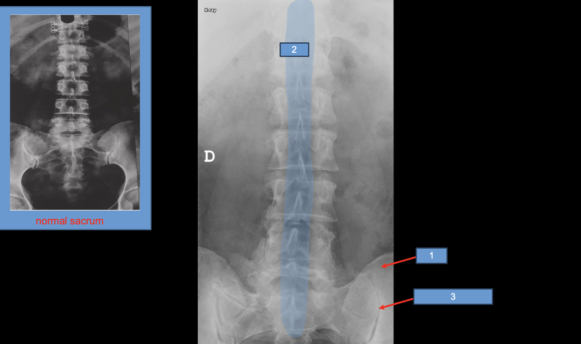 <p>2 (What vertebrae not the blue box <span data-name="slightly_smiling_face" data-type="emoji">🙂</span> )</p>