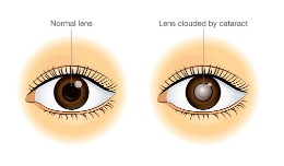 <p>= troebelingen van de lens</p><ul><li><p>kan op verschillende leeftijden voorkomen &amp; vele vormen aannemen</p></li><li><p>congenitaal cataract (aanwezig bij de geboorte)</p><ul><li><p>relatief zeldzaam, maar kan desastreuze gevolgen hebben voor normale visuele ontwikkeling als het niet snel wordt behandeld wanneer het beeldkwaliteit thv netvlies ernstig verstoort</p></li></ul></li><li><p>prevalentie van verworven cataract</p><ul><li><p>neemt toe met leeftijd → rond 70 jaar bijna iedereen enig verlies van transparantie</p></li></ul></li><li><p>behandeling:</p><ul><li><p>troebele lens wordt verwijderd &amp; vervangen door implantaat</p></li></ul></li></ul><p></p>