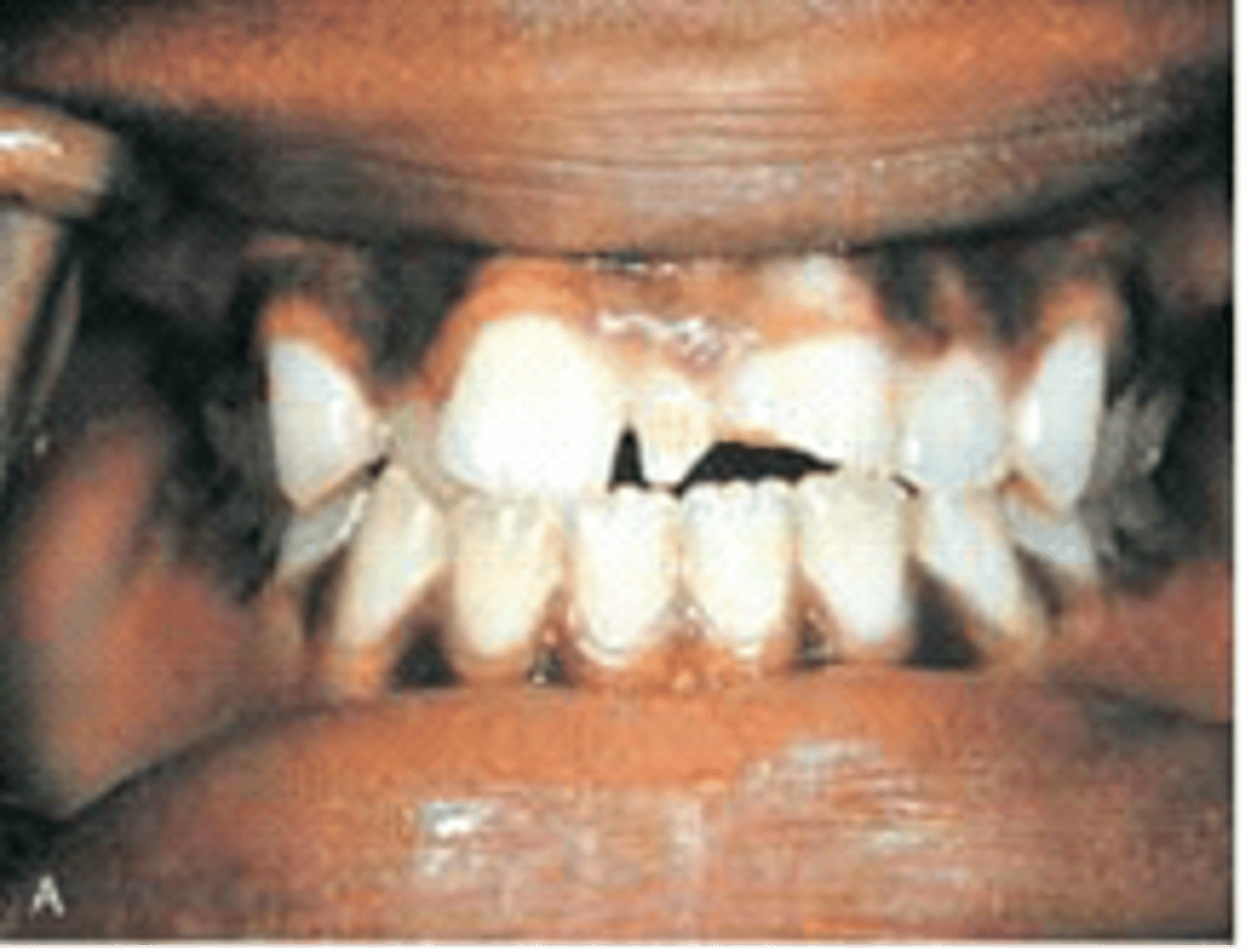 <p>Mesiodens</p>