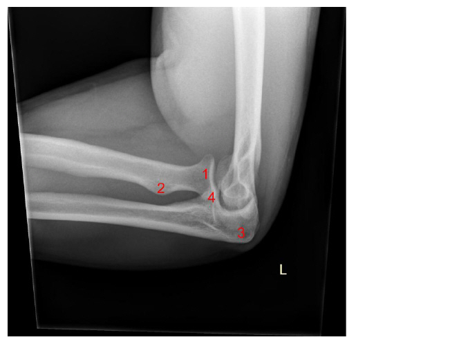 <p>What structure is #4?</p><p>A. Radial styloid</p><p>B. Coronoid process</p><p>C. Radial tuberosity </p><p>D. Olecranon process</p>