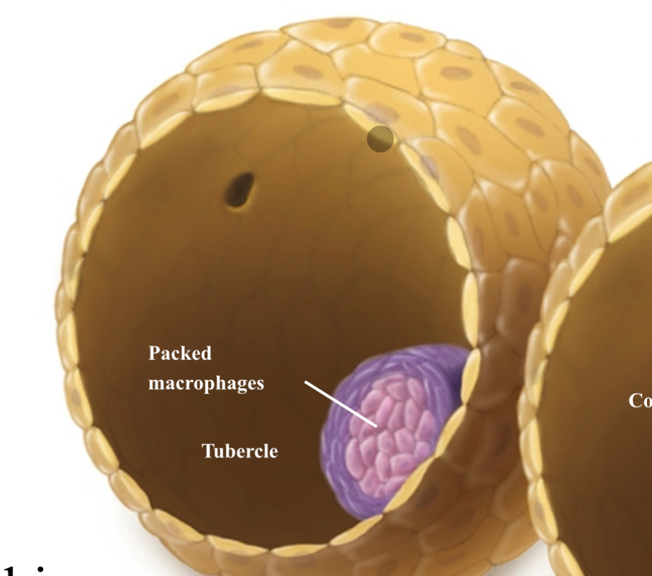 <p><span><span>Macrophages call in more immune cells, causing a tubercle</span></span></p><p><span style="background-color: transparent;"><span>Tightly packed macrophages surround the site of infection, forming a</span></span></p><p><span style="background-color: transparent;"><span>tubercle over a two- to three-month period.</span></span></p><p><br></p>