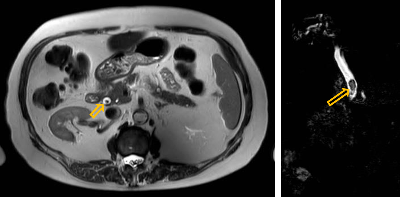 <p>Patient history: chronic right upper abdominal pain</p><p>Modality: T2W MRI (left); 3D MRCP (a heavily T2-weighted sequence, right), noncontrast studies</p><p>Region: upper abdomen, axial (left) and coronal (right) views Radiologic sign: filling defect in the fluid-filled, hyperintense common bile duct</p><p>Diagnosis: choledocholithiasis</p>