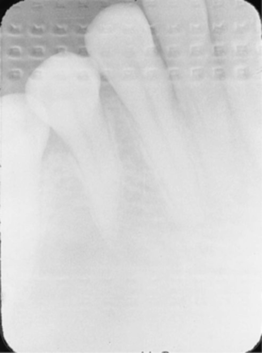 <p>-Light images with a herringbone pattern are seen</p><p>-Film was placed in the mouth backward/reversed and then exposed</p><p>-To avoid always note the front and back sides of the film before placing it in the patient's mouth</p>