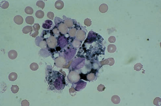 Figure 11: Macrophages showing erythropagocytosis