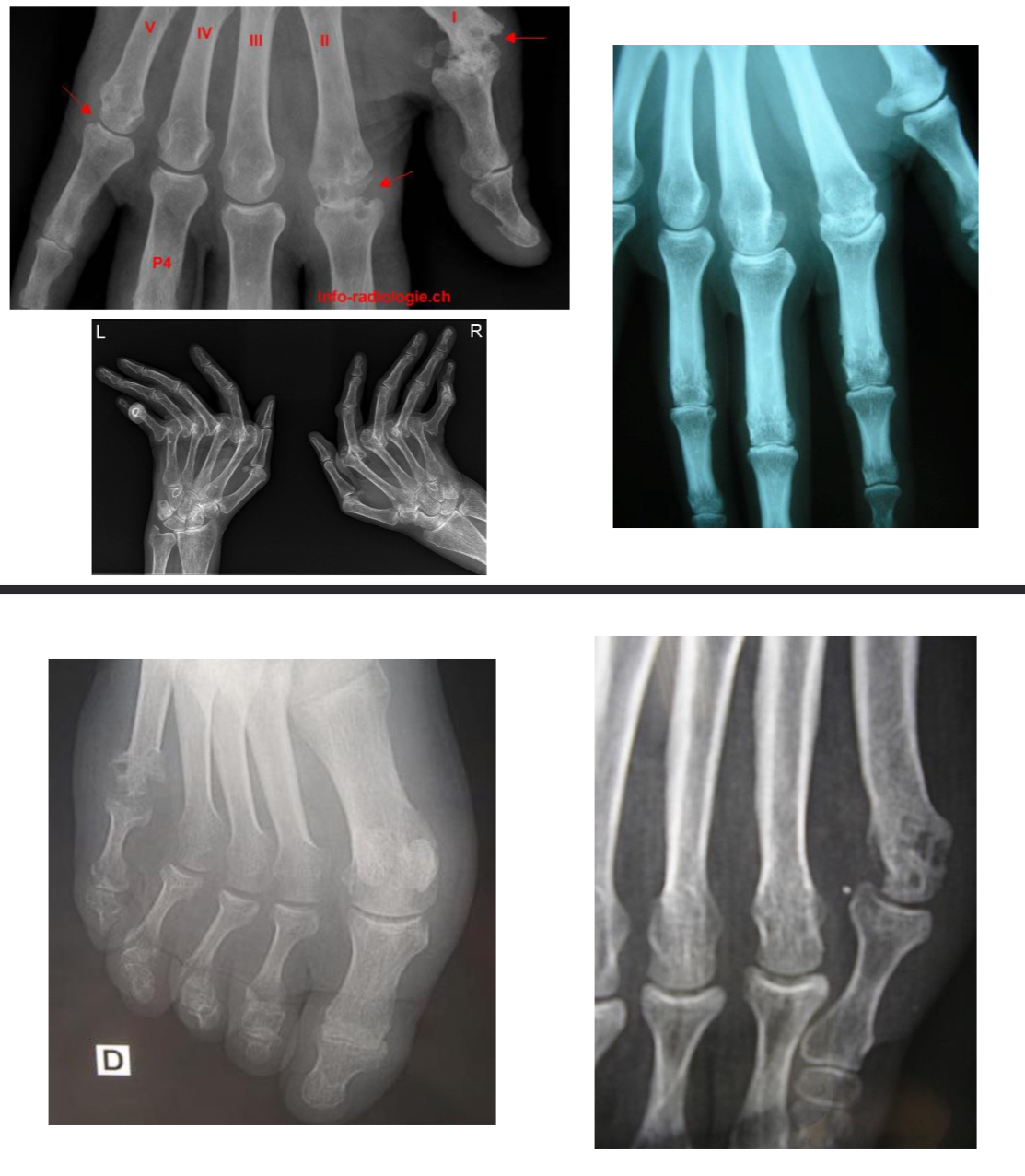 <p>= réponse immunitaire incontrôlée : production d’auto-anticorps comprenant le facteur rhumatoïde (FR) et les auto-anticorps anti-protéines citrullinées (ACPA), réactions inflammatoire  membrane synoviale (synovite) </p><p>Radio :</p><ul><li><p>normale si PR débutante </p></li><li><p>Mains et poignets : F </p></li><li><p>Pieds : F+ 3/4 </p></li><li><p>Autres articulations douloureuses : F + P</p></li><li><p>Thorax:bilan pré-T </p></li><li><p>Lésions structurales : érosions osseuses, pincement des interlignes articulaires (carpe, MCP, IPP et MTP)</p></li></ul><p></p><p>Écho : recherche épanchement liquidien intra-articulaire, synovite, ténosynovite, érosions osseuses infra-radio </p><p></p><p></p>
