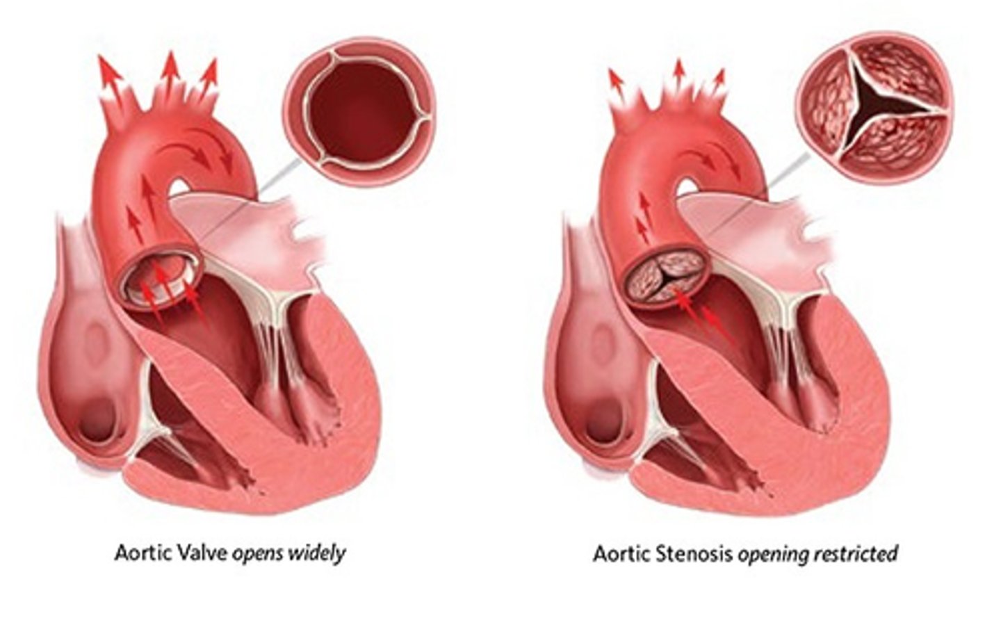 <p>aortic stenosis</p>