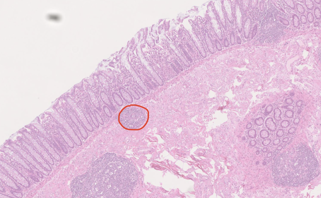 <p>I lamina propria finns ansamlingar av mogna lymfocyter. </p>