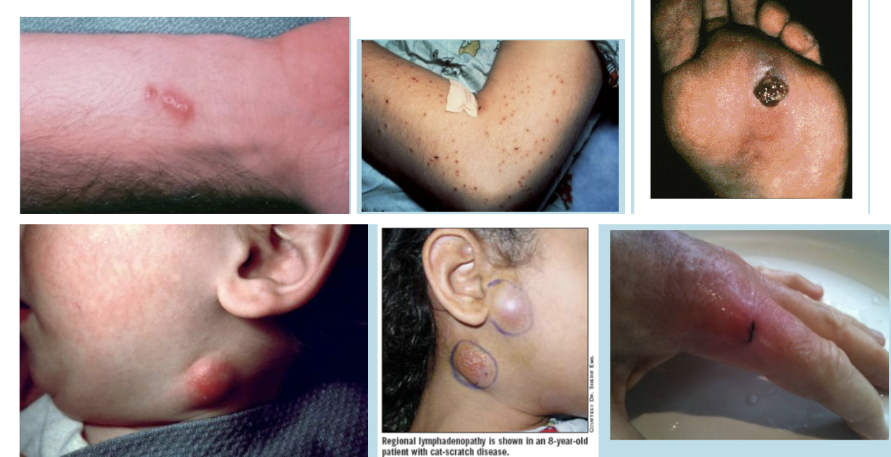 <ul><li><p>Mild infection at the point of injury, lymph nodes, especially those around the head, neck, and upper limbs, become swollen.</p></li><li><p>Fever, headache, fatigue, and a poor appetite for about a week.</p></li><li><p>Rare complications of Bartonella infection are bacillary angiomatosis (reddish elevated lesions often surrounded by a scaly ring) and or severe eye lesion in case of eye infection.</p></li></ul>