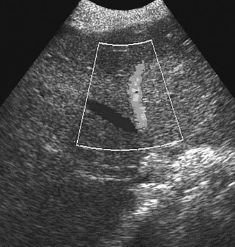 <p><span>A transverse duplex image of the liver displays:</span></p>