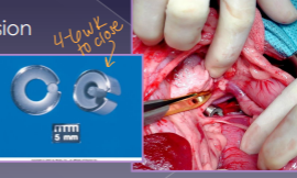 <ul><li><p><span style="color: rgb(136, 136, 136);"><strong>Et: </strong></span>genetic (single), acquired multiple (portal hypertension, cirrhosis)</p><ul><li><p>Often seen with<strong> microvascular dysplasia,<u> toxins circle systematically (ammonia)</u></strong></p></li></ul></li><li><p><span style="color: rgb(136, 136, 136);"><strong>Sig:&nbsp;</strong></span></p><ul><li><p><strong>Single Congenital:</strong> toy breeds (Extrahepatic), Himalayans (Ex), → most common</p><ul><li><p> Lg breeds (Intrahepatic)</p></li></ul></li><li><p><strong>Acquired multiple:</strong> older Lg breeds, cats</p></li></ul></li></ul><ul><li><p><span style="color: rgb(136, 136, 136);"><strong>Cs:</strong> </span><strong>seizures, head pressing, dull mentation, post-prandial dullness, <u>copper-colored irises(cats)</u>, straining, <u>ammonium</u> biurate stones</strong></p></li></ul><ul><li><p><span style="color: rgb(136, 136, 136);"><strong>Dt:</strong></span> low BUN/cholesterol/albumin; high liver enzymes and bile acids; US, CT</p></li></ul><ul><li><p><span style="color: rgb(136, 136, 136);"><strong>Tx:</strong></span><strong> </strong>Clavamox, lactulose, low protein diet, Keppra, <u>Sx attenuation</u> <strong>(ameroid ring, cellophane band)</strong></p><ul><li><p>Min. 2w medical tx even pre-Sx</p></li><li><p>Risk of portal hypertension, portal atresia w/ Sx</p></li></ul></li></ul><p></p>