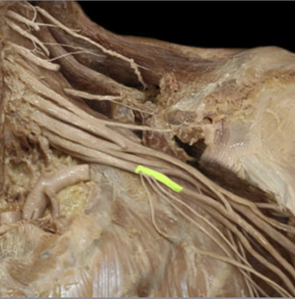 <p><em>table 7, terminal branches are ulnar n and median n</em></p>