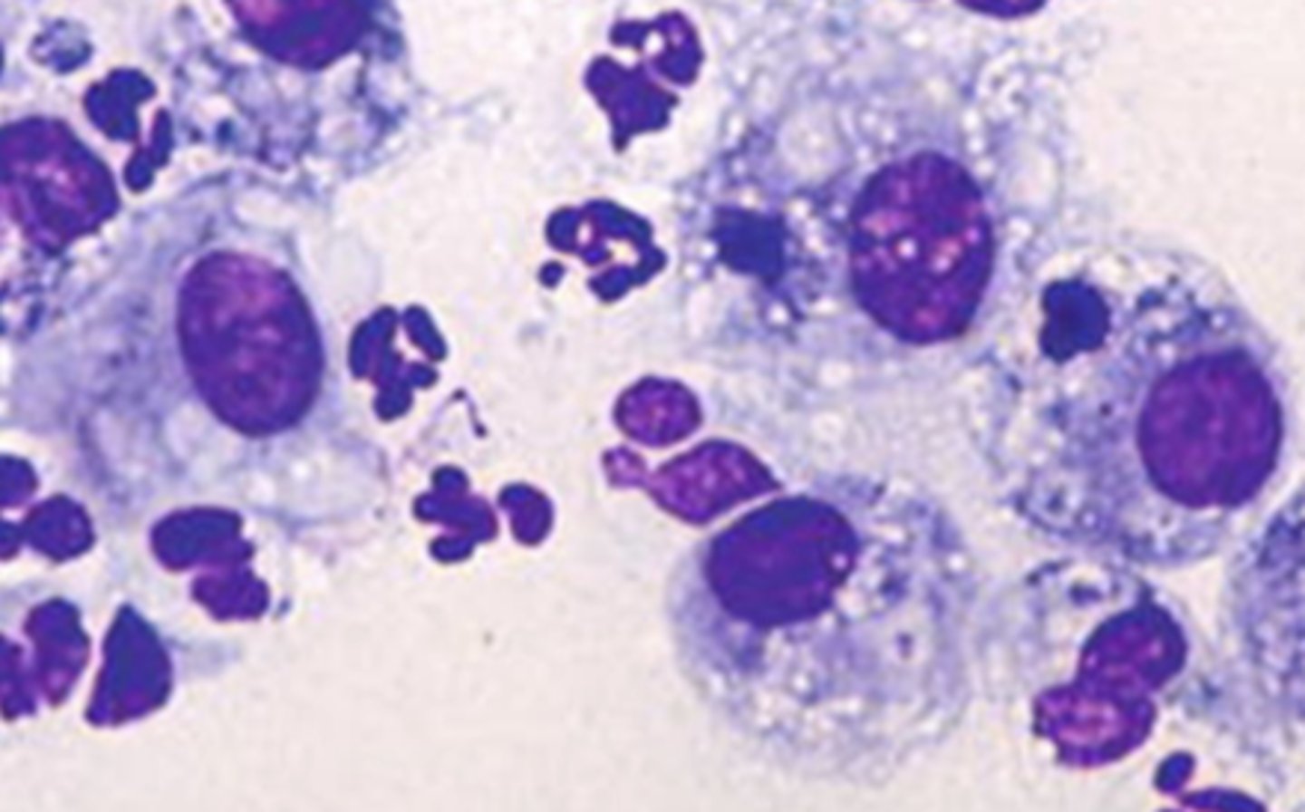 <p>What type of inflammatory cells are these?</p>