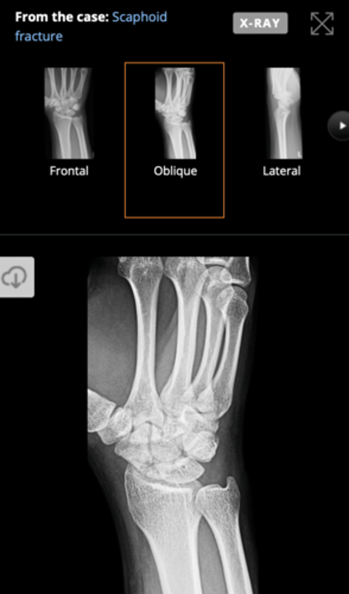 <p>The wrist is studied radiologically with PA/AP and lateral projections, including specific projections for certain bones like the scaphoid (oblique projection) and pisiform, as well as assessments of stability in various positions.</p>