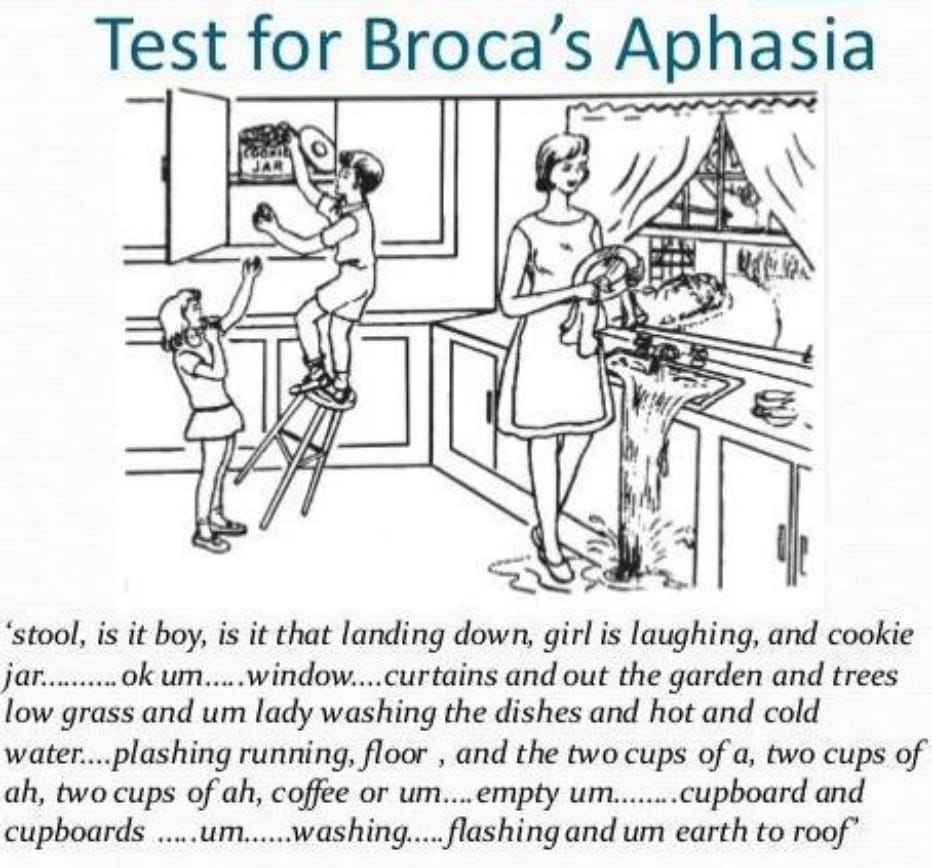 <p>Brocca afazi</p><p>agrafi (yazı yazamama) ve hemiparezi (özellikle yüzde) eşlik eder</p>