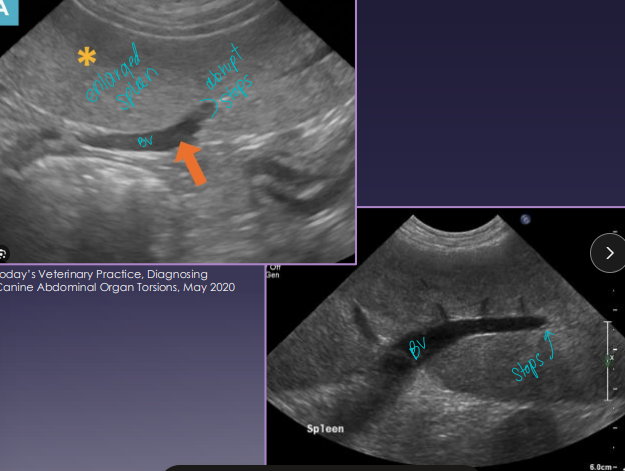 <ul><li><p><span style="color: rgb(136, 136, 136);"><strong>Et:</strong></span><strong> </strong>spleen twists on pedicle, congestion, necrosis</p><ul><li><p><strong><u>splenic artery and vein</u></strong></p></li></ul></li><li><p><span style="color: rgb(136, 136, 136);"><strong>Sig:</strong></span><u> Lg-breed dogs</u></p></li><li><p><span style="color: rgb(136, 136, 136);"><strong>Cs:</strong></span> <strong><u>shock(acute)</u></strong>, anorexia, V/D, pain, enlarged spleen, <strong><u>hemoglobinuria(chronic), VPCs</u></strong></p></li><li><p><span style="color: rgb(136, 136, 136);"><strong>Dt:</strong></span></p><ul><li><p><strong>Rads:</strong> abnormal location, mass effect, gas bubbles, comma-shaped spleen</p></li><li><p><strong>US:</strong> variable echotexture, dilated vessels, thrombi</p></li></ul></li><li><p><span style="color: rgb(136, 136, 136);"><strong>Tx: </strong></span>splenectomy <strong><u>DO NOT untwist, </u></strong>Unasyn </p><ul><li><p>necrotic debris → emboli risk</p></li></ul></li></ul><img src="https://knowt-user-attachments.s3.amazonaws.com/94c4d23a-ee08-4682-bc4d-4c3082b0e3b4.png" data-width="50%" data-align="center"><p></p>