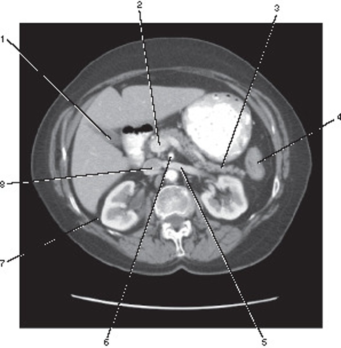 <p>This image of the abdomen was most likely acquired in which in which renal enhancement phase?</p>
