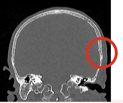 <p>Forceful trauma → break in the continuity of skull with or without damage to the brain; classified by types and location.</p><ul><li><p><strong>Simple (linear)</strong>: break in continuity of bone.</p></li><li><p><strong>Comminuted</strong>: splintered or multiple fracture.</p></li><li><p><strong>Depressed</strong>: skull bones displaced by force downward.</p></li><li><p><strong>Open vs. Closed Fractures</strong>: Open = scalp laceration or tear in dura; Closed = dura intact</p></li></ul><p></p>