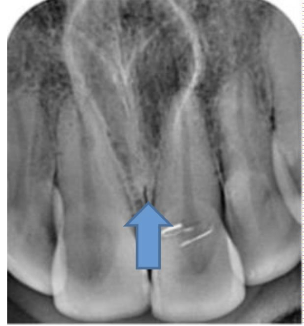 <p>A 23 year old presenting with a cystic swelling in midline in the anterior region of palate. Provide differential diagnosis</p>