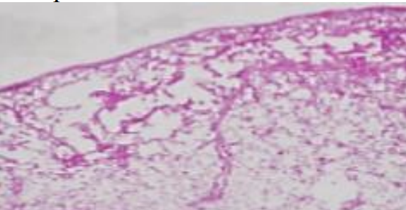 <p>Según la siguiente microfotografia de parenquima pulmonar, ¿cuál es el diagnostico mas probable?</p>