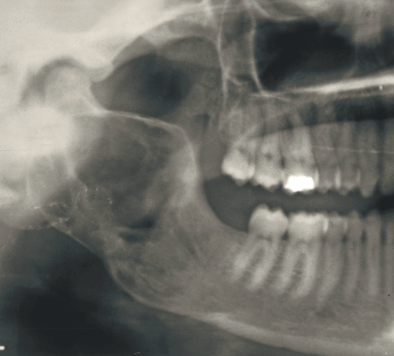 <p>Ameloblastoma</p><p>OKC</p><p>Odontogenic myxoma</p><p>Solitary bone cyst</p><p>Basal cell naevus syndrome</p><p>Cherubism</p><p>Metastatic malignancy</p>