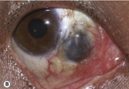 <p>Scleral thinning begins at the surgical site and does <strong>not involve the entire eye</strong>.</p>