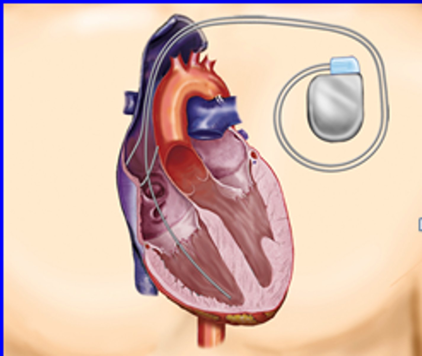 <p>automatically terminates arrhythmia's by delivering low-energy shocks to the heart</p>