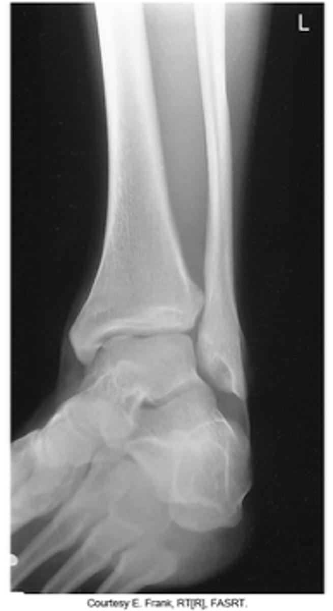 <p>- 45° medial rotation</p><p>- CR midway between malleoli</p><p>- Distal tibiofibular joint open</p><p>- Distal ⅓ of tibia and fibula demonstrated</p><p>- Proximal ½ of metatarsals included</p><p>- Optimal exposure factors</p>