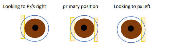<p>If you are assessing the fit of a soft contact lens for a patient’s left eye, and you see the following lens behaviour, which of the following is the most accurate record keeping? 2 marks</p><p> Decentred inferiorly, 100% nasal lag </p><p> Decentred inferiorly, 100% temporal lag </p><p> Decentred nasally, 100% temporal lag </p><p> Decentred nasally, 100% nasal lag </p><p> Decentred superior, 100% downgaze lag </p><p> Decentred superior, 100% upgaze lag </p><p> Decentred temporally, 100% nasal lag </p><p> Well centred, no lag </p>