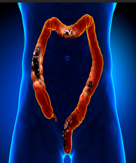 <p><strong>Colorectal Cancer: Background</strong></p><p>-Epidemiology → most common in those > __, incidence slowly rising in those 20-54 </p><p>-Pathology → >90% arise from adenomatous polyps, leading to ____________</p><ul><li><p>Takes 10-15 yrs </p></li></ul><p></p>